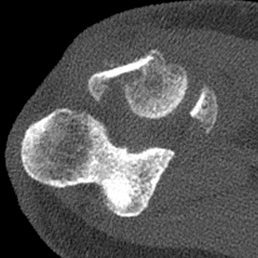 Fracture tête radiale - Var Membre Supérieur