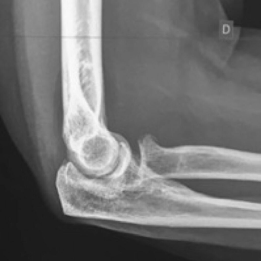 Fracture tête radiale - Var Membre Supérieur